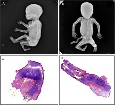 New pathogenic variant in DLX5: New clues for a clinical spectrum from split-hand-foot malformation to fibular aplasia, tibial campomelia and oligosyndactyly